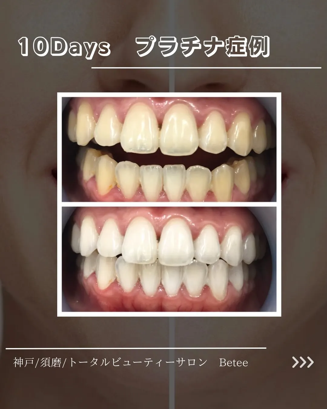 @whitening_betee