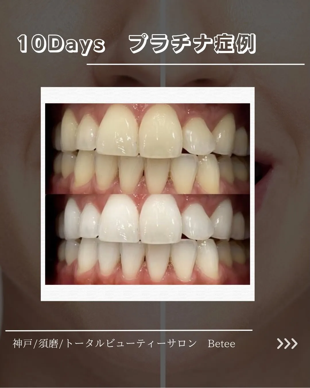 @whitening_betee 