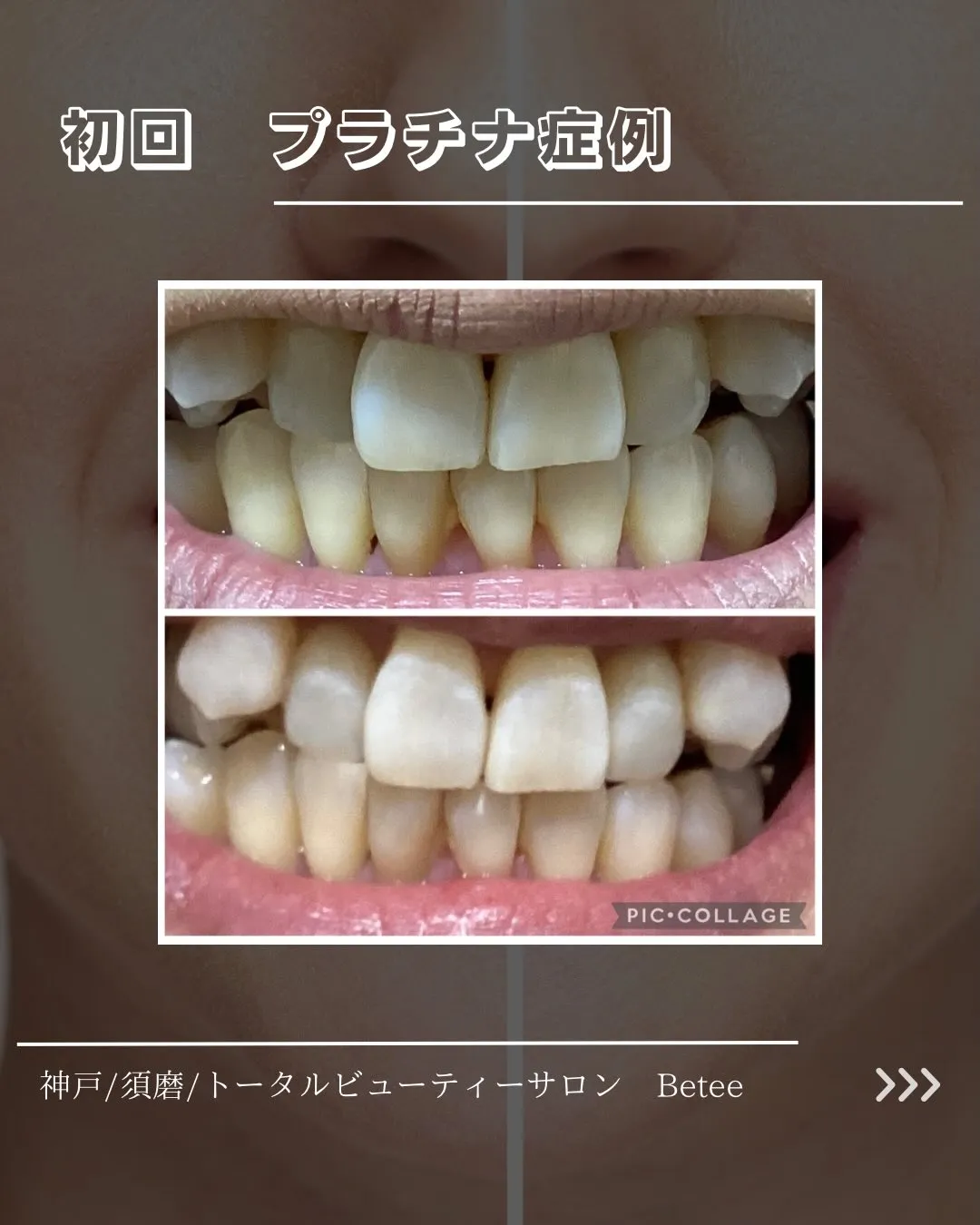 @whitening_betee 